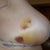 Post op day 7 side