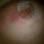 This is where my skin used to be....it is now in the trash with the piece of tape that took it.