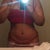 Front view-day after surgery
