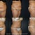 It is amazing to see the difference! This is two months post-op and I still have some swelling. I can't wait to see how amazing the results are when the swelling has completely resolved!!