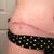 post-op 3 weeks scar