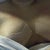 post op clevage