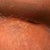Right side, very swollen but spitting stitches have healed except for one tiny spot. Suture line looks amazing and will be even tighter once the swelling goes down! If all continues well no need for a revision and scar should be as nice as the left side!