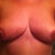 5 weeks post-op.