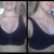 3 weeks post op wearing sports bra