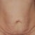 Front view Pre op