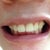 Second tray with no invisalign on, notice the deep bite