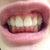 10th tray with no invisalign on. Improvement