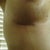 booby scar