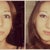 Left: before front view (sorry for the crazy look in my eyes :P) Right: 11 weeks post op front view