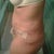 1 day post op