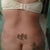 1 day post op