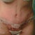 1 day post op