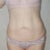 forward view. I have less skin than most 115 lb weight loss patients, likely because I lost mine over a 3 year period when i was relatively young.