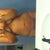 Week and a half after smartlipo
