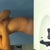 Week and a half after smartlipo