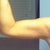 Week and a half after smartlipo