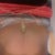 Still have swelling on the side from lipo day 7