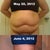 The night before my TT and 2 weeks Post Op
it makes me tear up knowing I have a body I am no longer ashamed of!