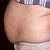 Before pic - The day of surgery
