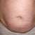 Before pic - The day of surgery