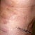 The day after surgery.