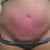 4 weeks post op