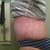4 weeks post op - lots of swelling still