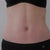 3 weeks post-op front view