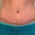 Almost 9 wks po. My scar, healing nicely. Almost 9wks post op. still pulling my BB over due to the swelling on my left side. Pleating has flattened out quite a bit.