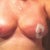 15 DAYS POST OP