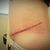 after tummy tuck
