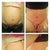 before and after tummy tuck