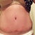 6 weeks post op, holes getting smaller, but I am very swollen as you can see!