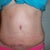 2 months post op!  I LOVE my low scar, it's flat and except for the minor "splits" in the center, it has healed so nicely!
