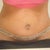 Almost 3 weeks out. It looks like the line is slightly lower than my c-section scar.