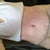 12/14, going to remove steri-strips