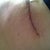 12/14 Hip scar