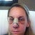 Day 3 post op. I don't even look like myself. Cheeks and whole face are very very swollen! I have peaked with swelling here.