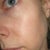 This is my face about 10 months after the last IPL. This was taken July of 2011. I have only had 2 IPLs but they really changed the texture of my skin quite a bit. This texture is very ugly and "aged". I am 37.