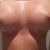 Day 3: 330 cc silicone over muscle. Very swollen!