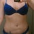 Stomach completely disfigured! The photo doesn't show just how bad it really is