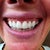 First veneers. Too big, too white, too opaque. Placed too close to the bone causing redness, swelling and bleeding