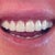 Second final veneers. Pretty happy except for the large  black triangle gaps between both lateral incisors.