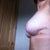 10 DAYS POST OP