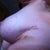 10 DAYS POST OP - NO MORE BLOOD BUBBLE!