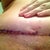 Incision scanning over and healing well