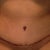 Incision beginning to heal although I'm SUPER swollen