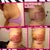 Progression of side view, look how fast my bruising is disappearing.