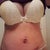 2wks PO Steri-Strips changed, bruising fading and drain holes healing well. So glad my tummy is FLAT!! :D